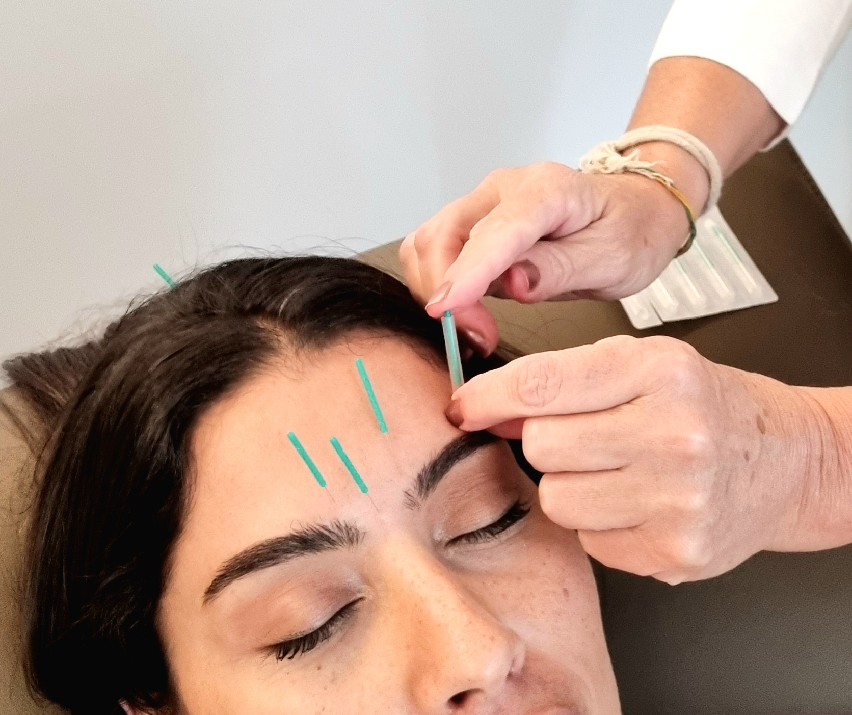 Cosmetic Acupuncture- What is it?